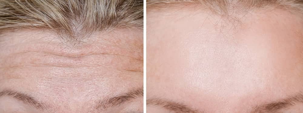 Dermal fillers used on womans forehead. Before and after picture.