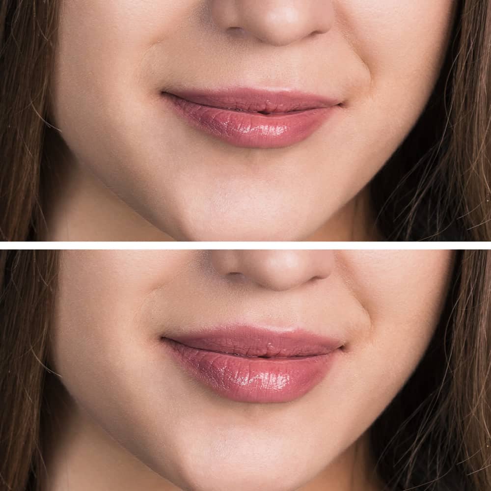 Woman with lip fillers. Before and after picture.
