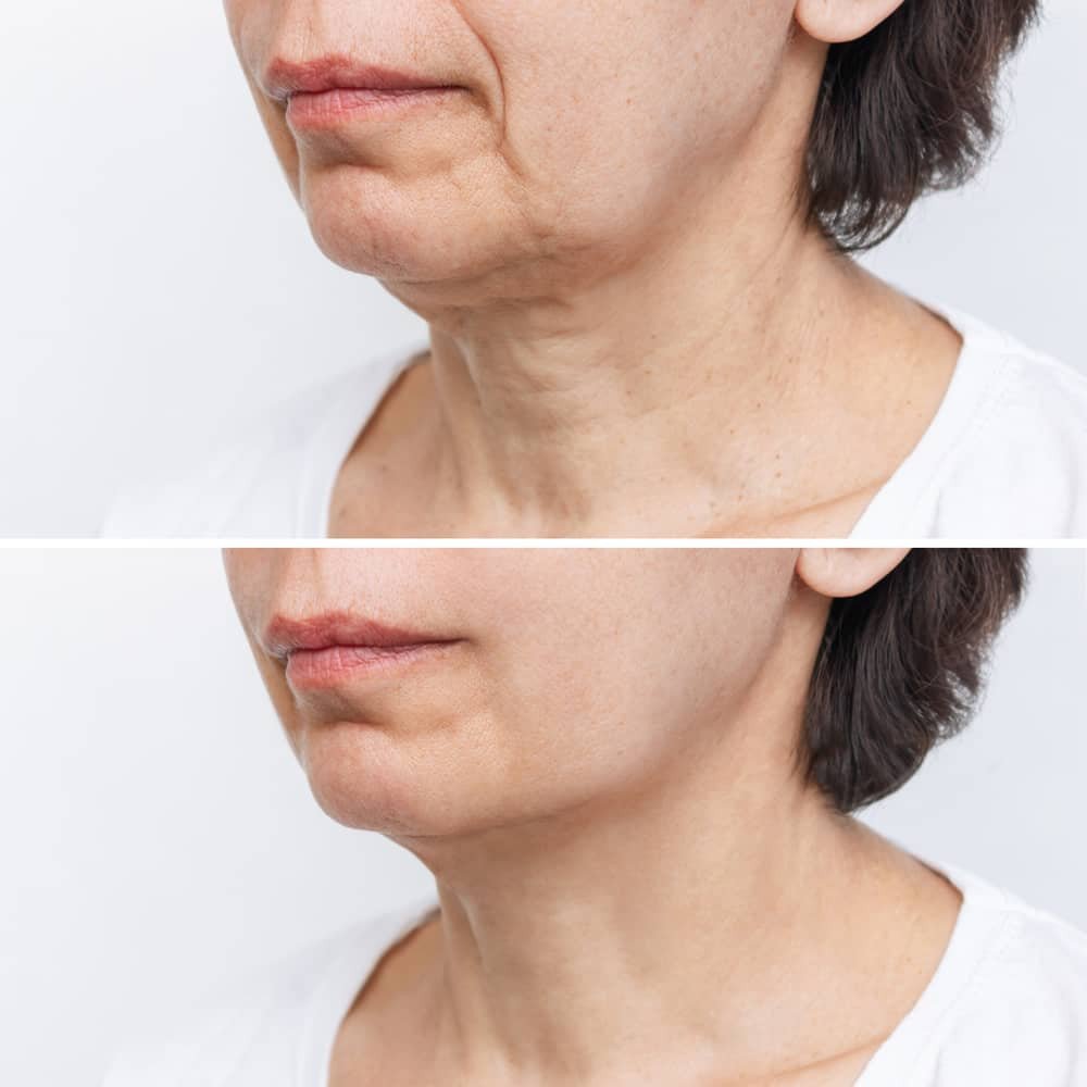 Sculptra before and after picture.
