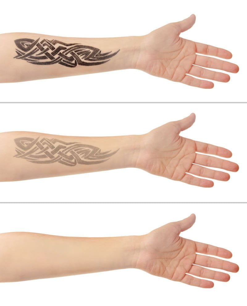 Tattoo Removal before & after