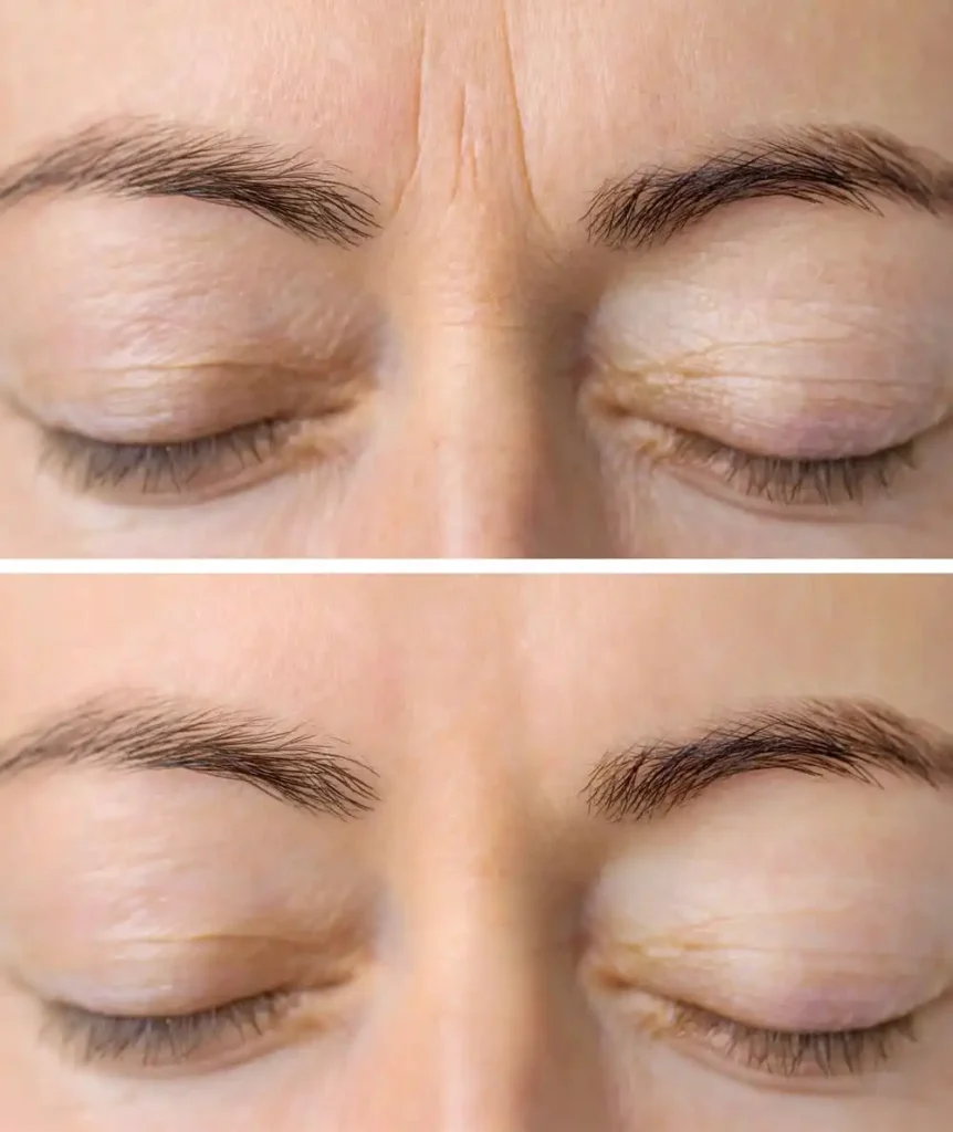 Botox Treatment before and after closing their eyes