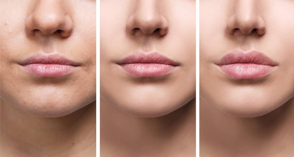 Dermal Fillers