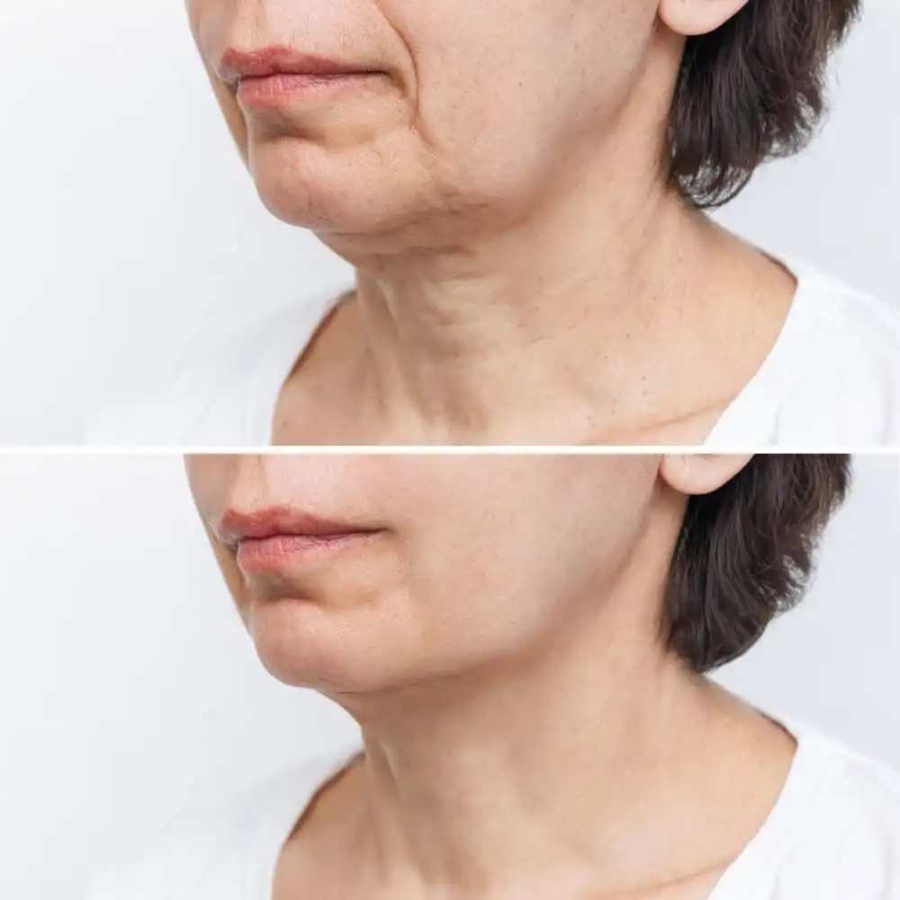 Sculptra Before and After